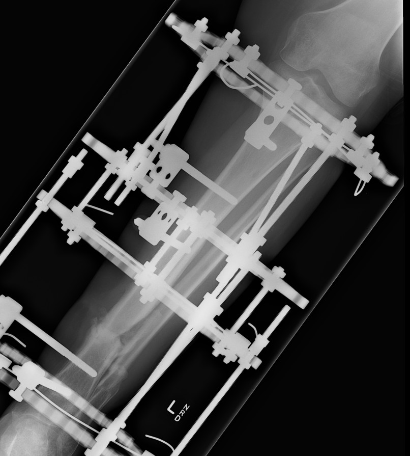 Infected Tibial Non Union Ilizarov AP